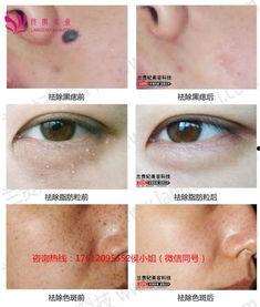 点痣笔视频,轻松去除瑕疵,焕发肌肤光彩