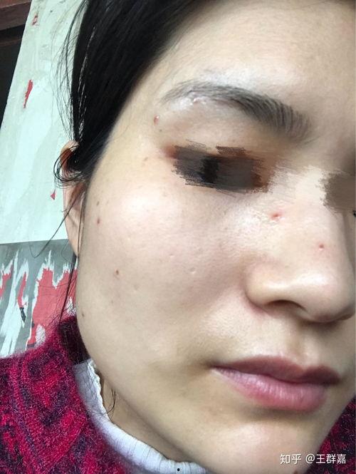 点痣笔视频,轻松去除瑕疵,焕发肌肤光彩