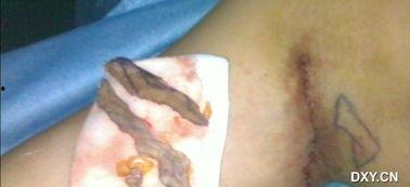 切除狐臭全视频,全视频揭秘狐臭切除手术全过程