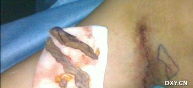 切除狐臭全视频,全视频揭秘狐臭切除手术全过程